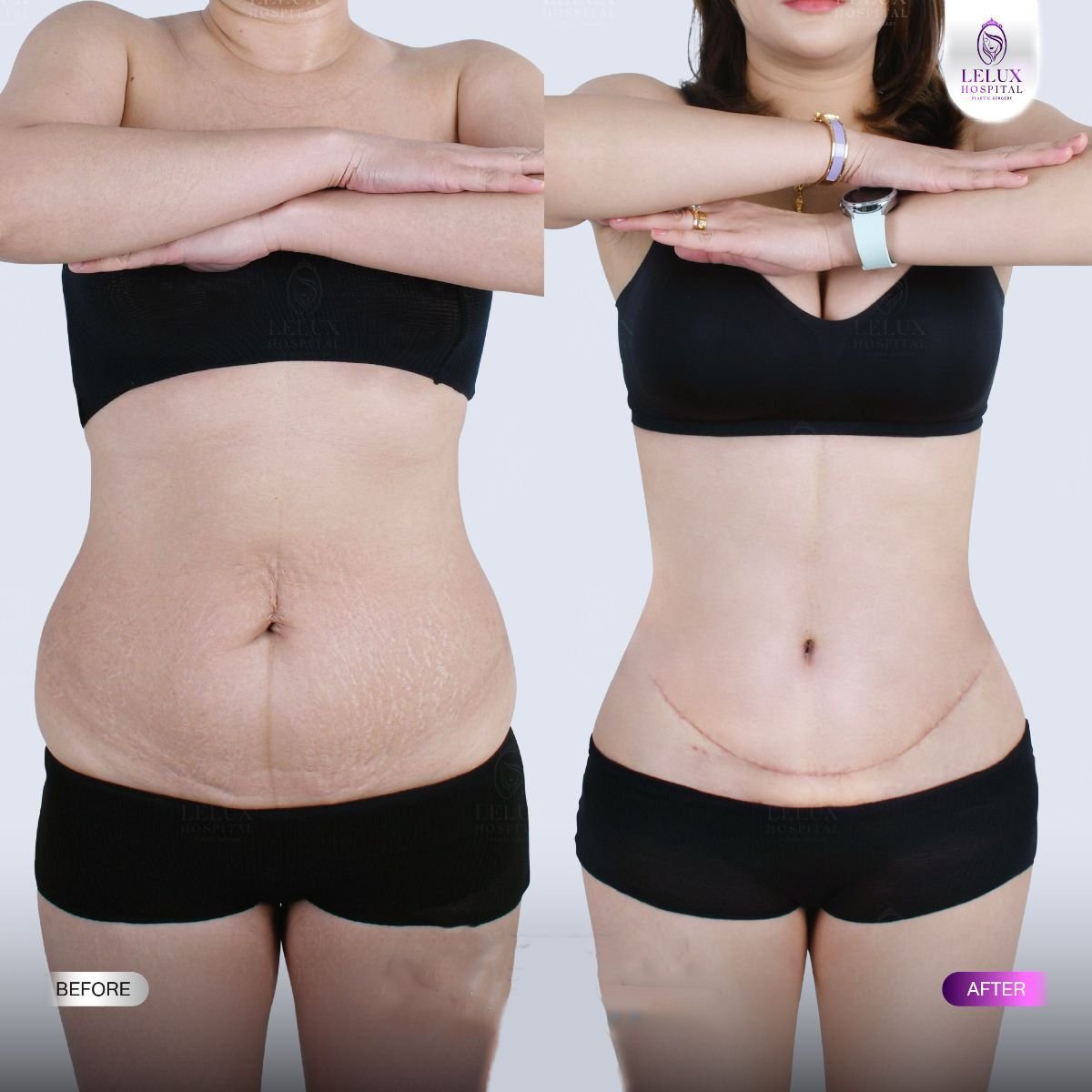 Resultados de abdominoplastia antes y después en Lelux Hospital – mejora del contorno abdominal