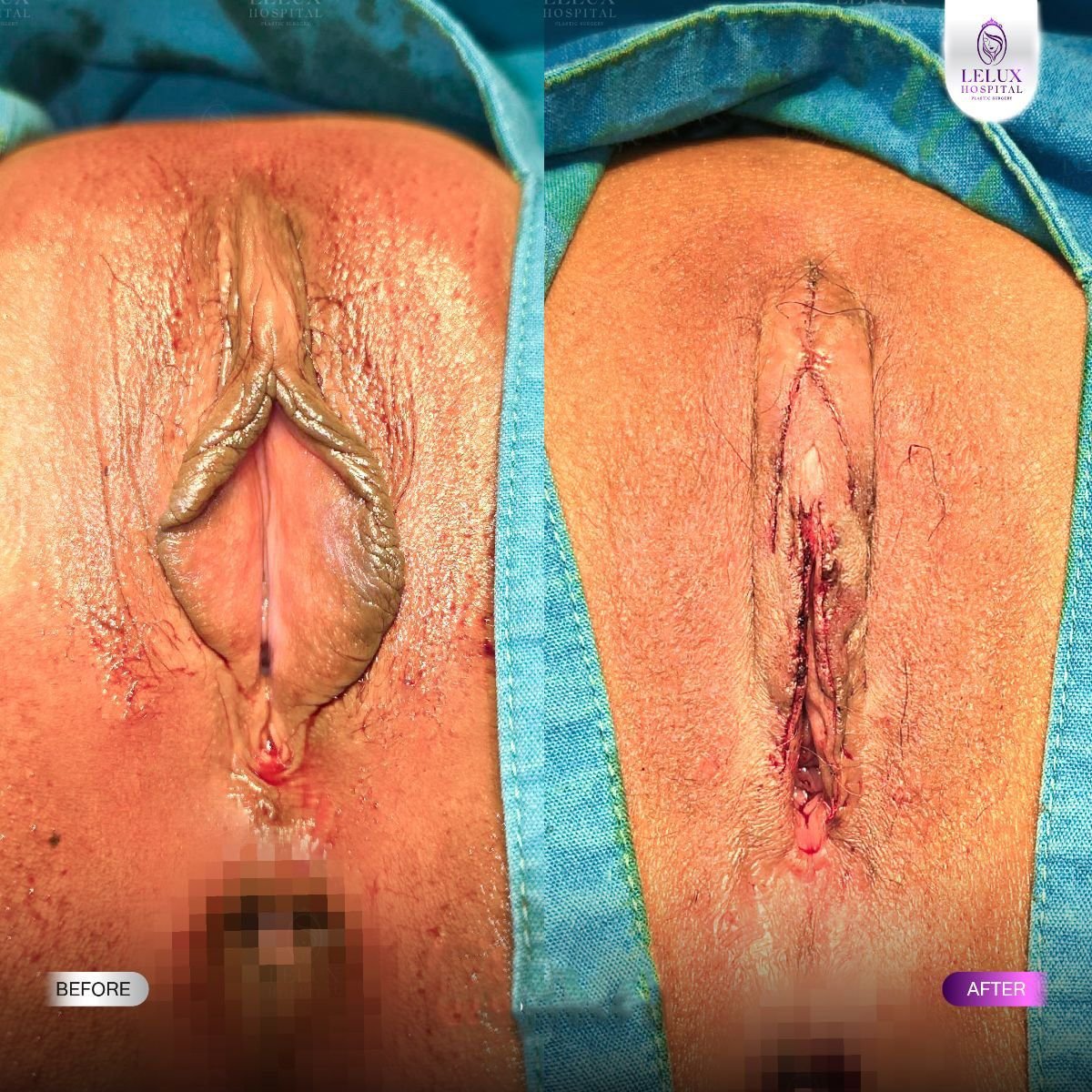 Resultados de antes y después de labioplastia en Lelux Hospital – reducción y contorno de labios