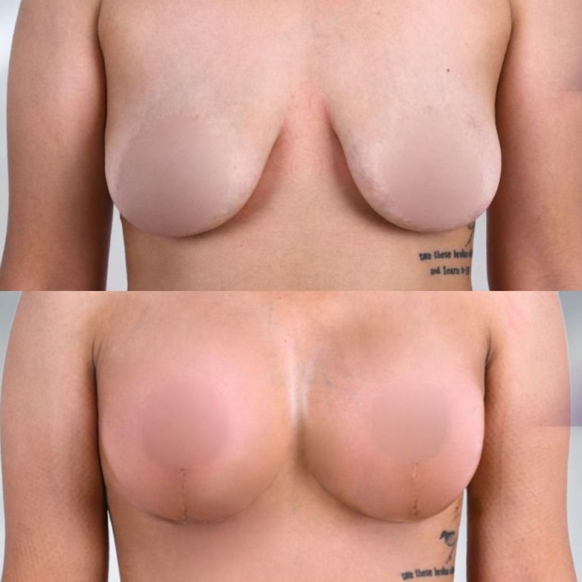 Résultats avant/après lifting mammaire avec implants ronds, forme et volume améliorés