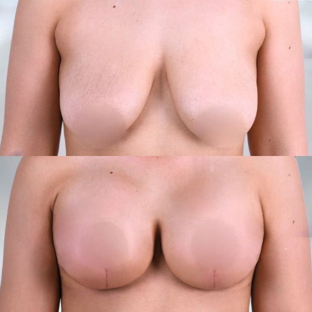 Résultat avant/après lifting mammaire avec implants ronds – forme et volume améliorés