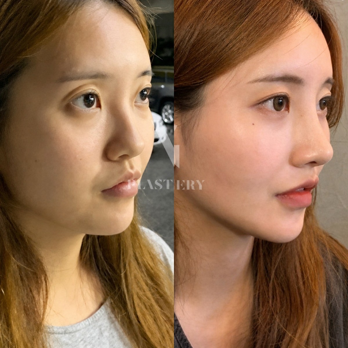 Результаты ринопластики до и после в VG Plastic Surgery, естественная форма носа