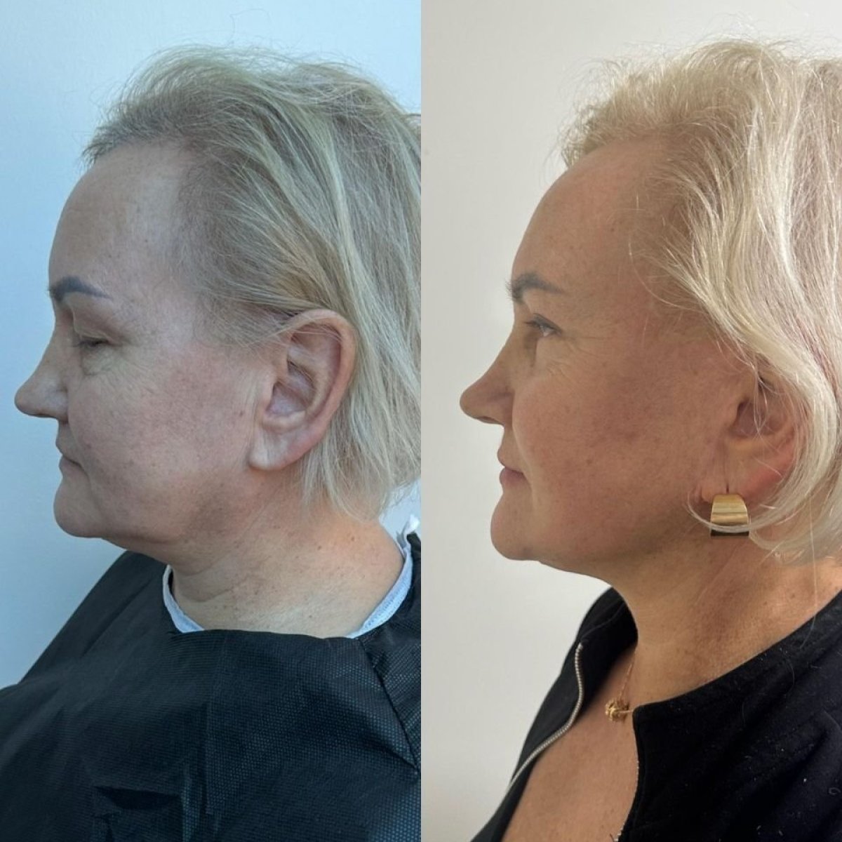 Before and after deep plane facelift results at Büyük Anadolu Hospitals (BAH International)