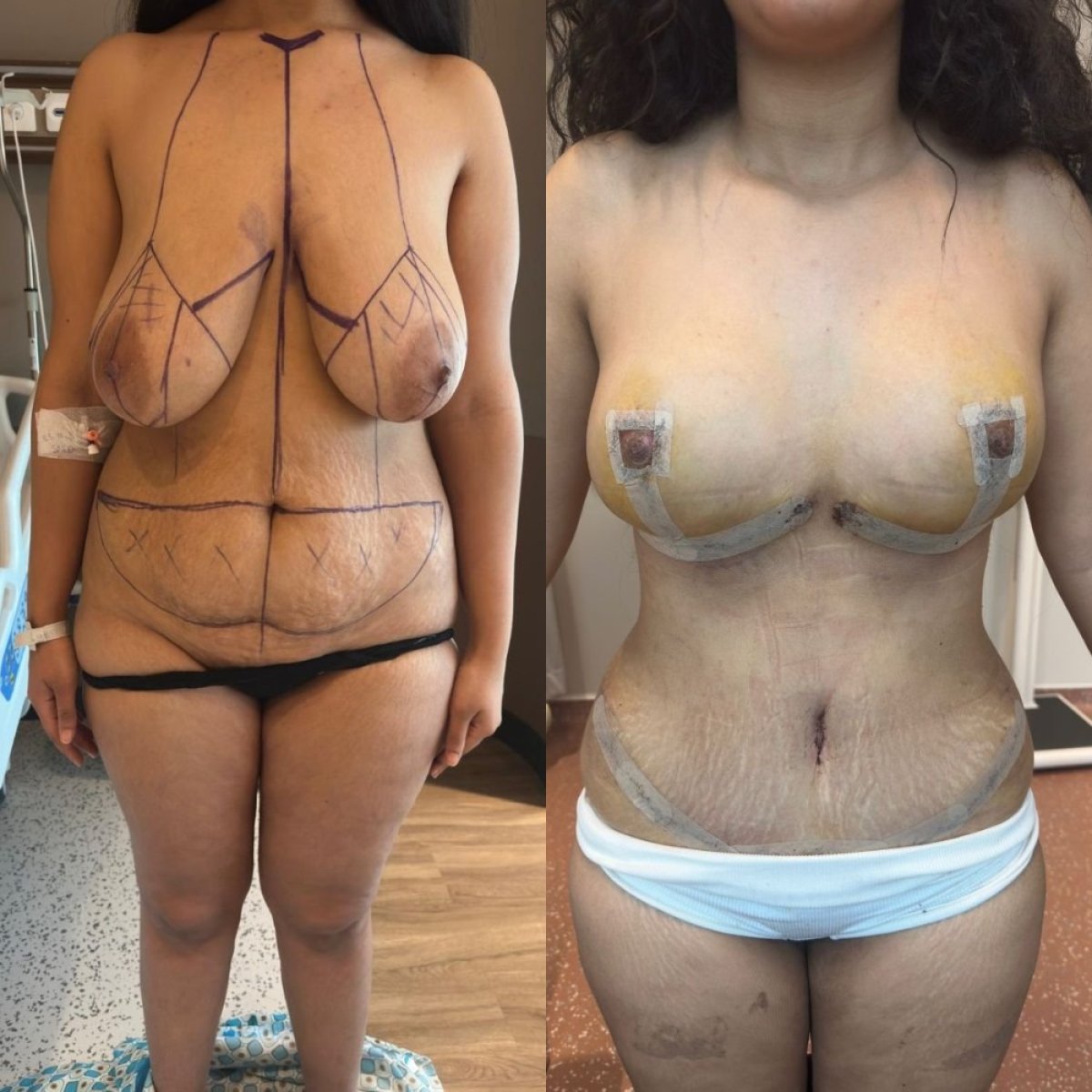 Resultados antes y después de mastopexia en Memorial Göztepe Hospital, mejor contorno mamario