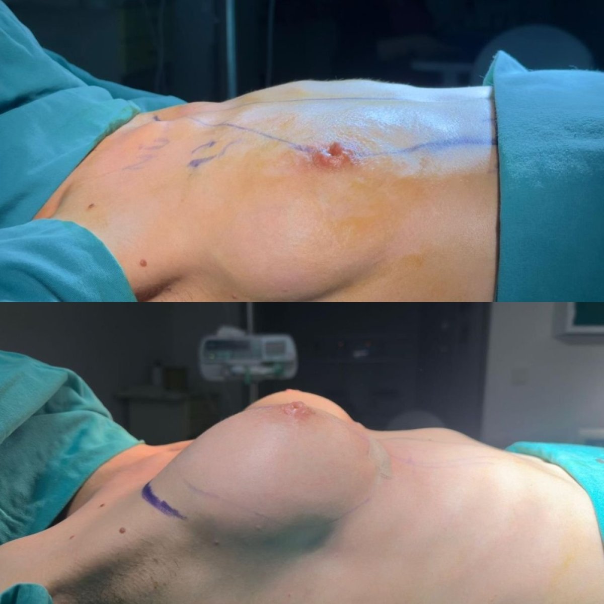 Resultados antes y después de mastopexia en Memorial Göztepe Hospital, mejor contorno mamario