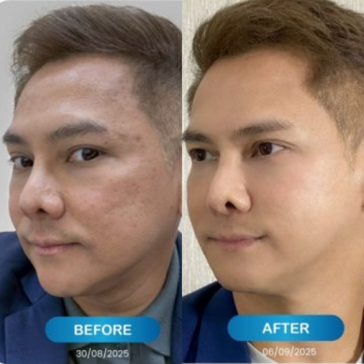 Before and after stem cell rejuvenation therapy results at Harmony Life Center, smoother skin