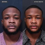 Facelift results by Dr. Choi Min Hyub - Patient’s before and after images Before and after Facelift photos by Dr. Choi Min Hyub