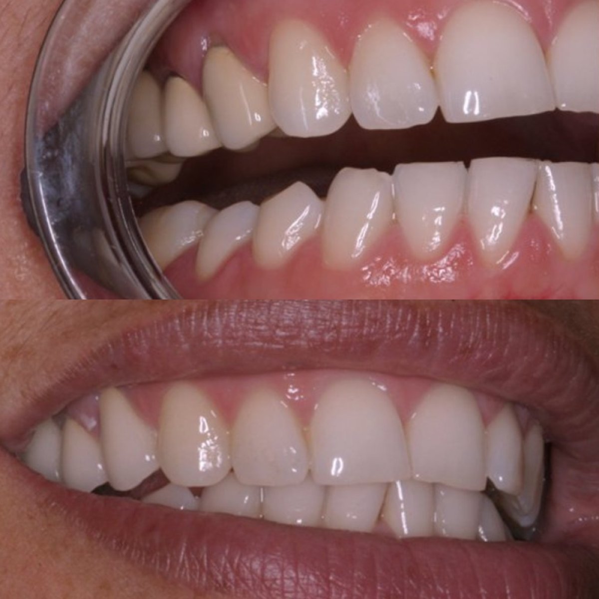 Before and after inlay/onlay dental restoration results – improved tooth shape and color