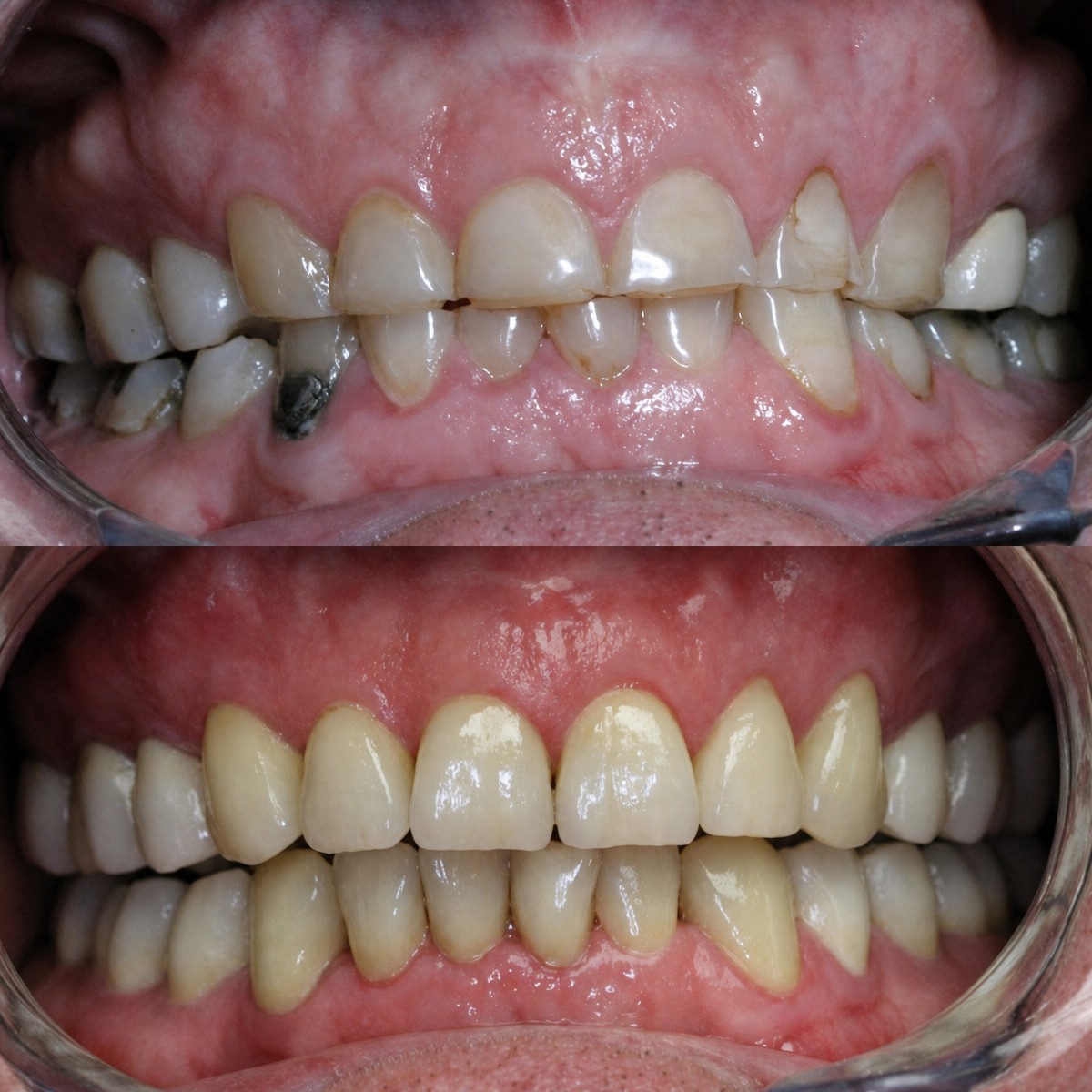 Before and after inlay/onlay dental restoration results – improved teeth appearance