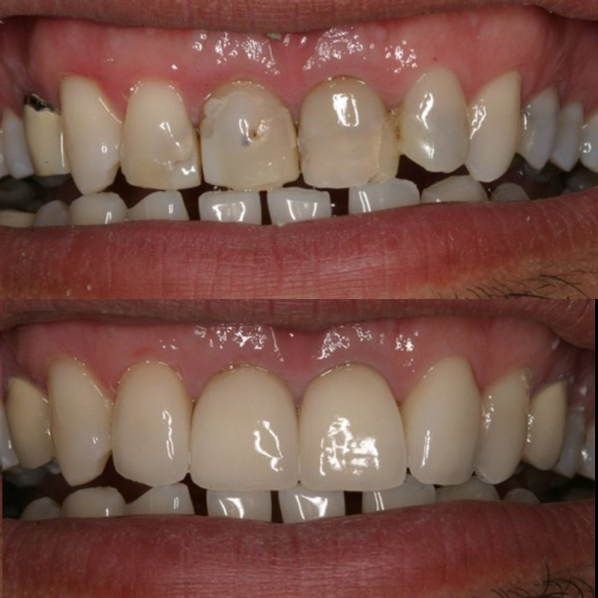 Before and after inlay/onlay dental restoration results – improved front teeth appearance