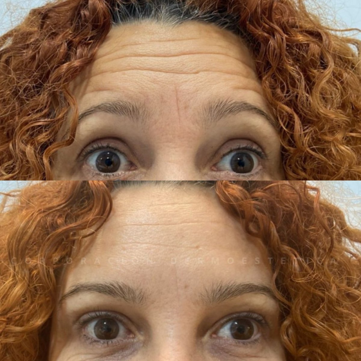 Before and after Botox injections for forehead wrinkles reduction, visible smoothing result