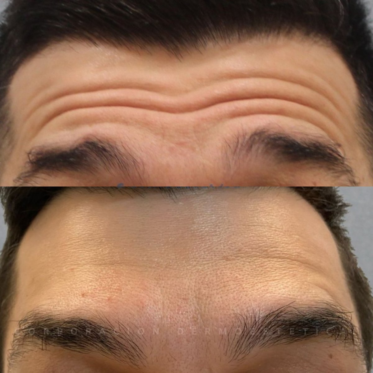 Before and after Botox injections for forehead wrinkles, visible smoothing result