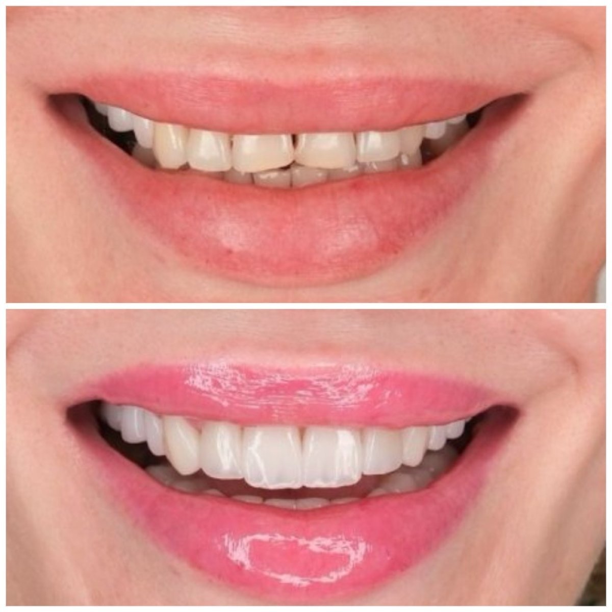 Before and after smile makeover results at YEG Clinic – improved teeth alignment and color