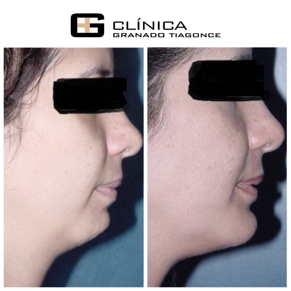 Before and after chin implant results at Clinica Granado Tiagonce, improved chin profile