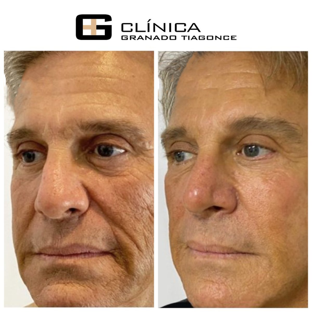 Résultats lifting visage avant/après à Clinica Granado Tiagonce, rajeunissement visible