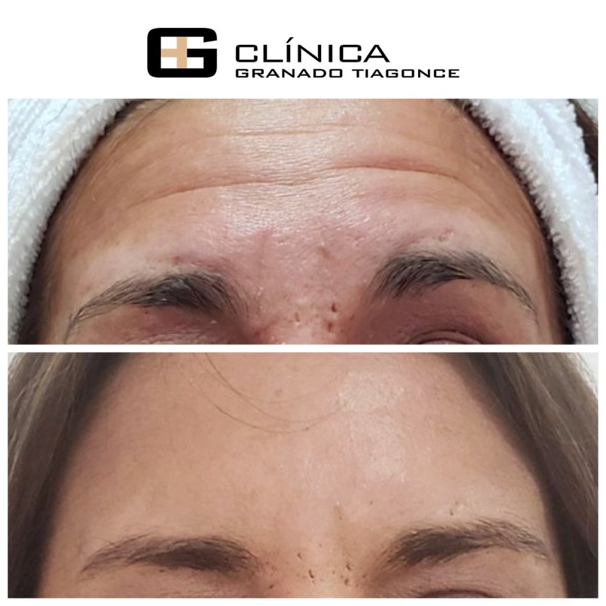Antes y después de inyecciones de bótox en Clinica Granado Tiagonce, frente más lisa