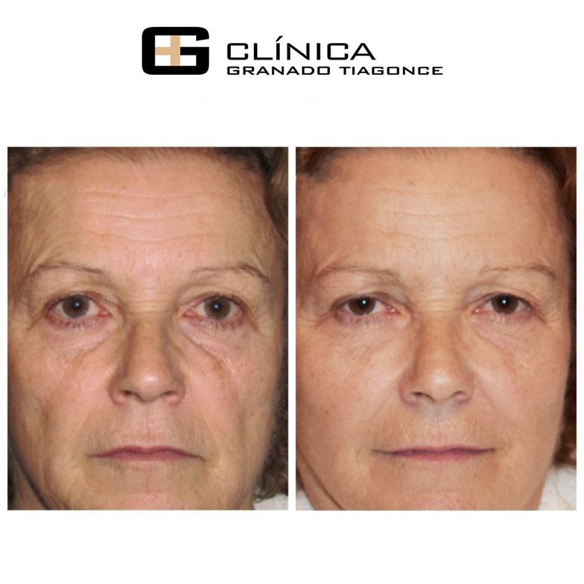 Результаты до и после фейслифтинга в Clinica Granado Tiagonce, омоложение лица