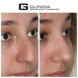 Ergebnisse der Rhinoplastik (Nasenkorrektur) durch Dr. — Vorher- und Nachher-Fotos des Patienten Fotos vor und nach Rhinoplastik (Nasenkorrektur) durch Dr.