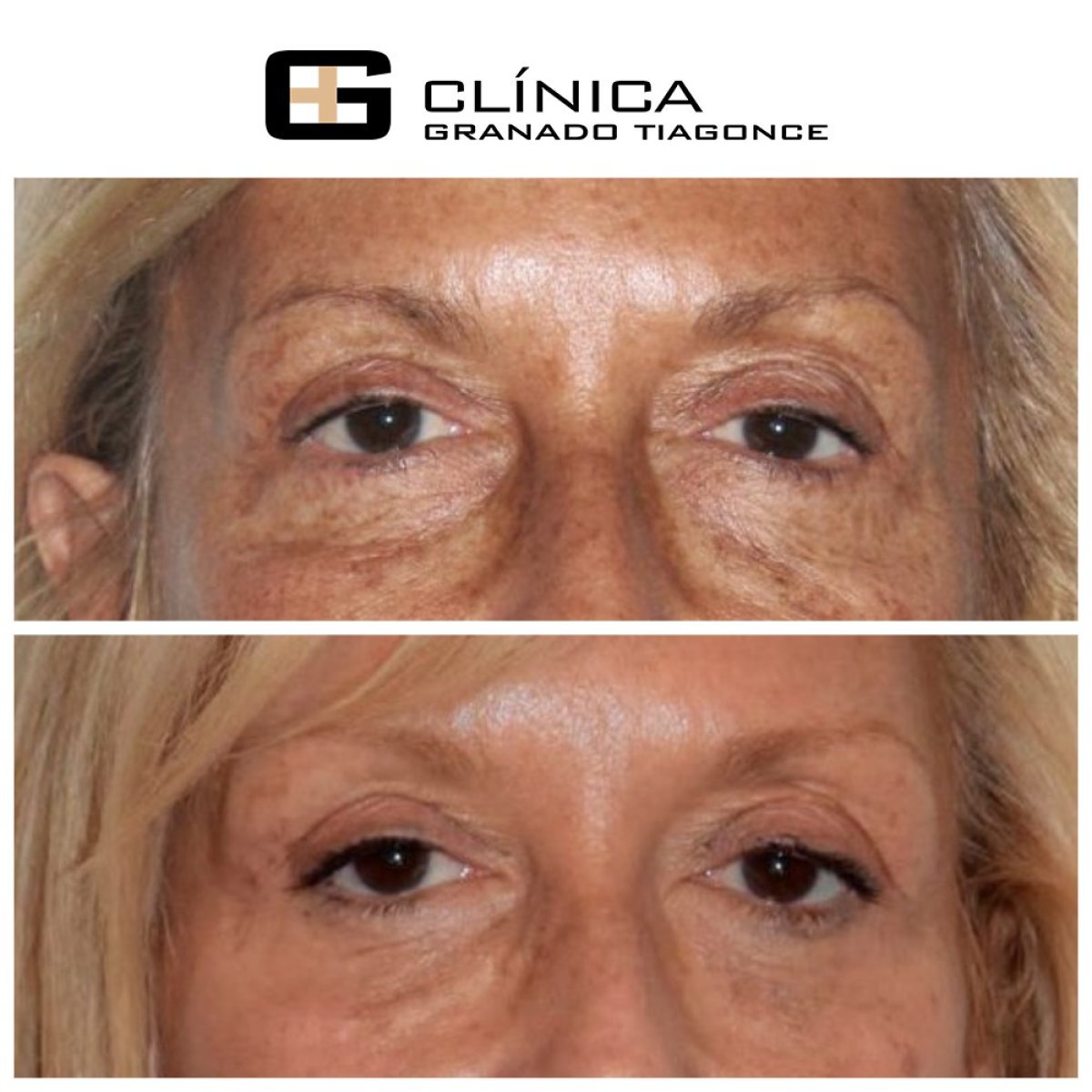 Résultats avant et après blépharoplastie à Clinica Granado Tiagonce, correction des paupières