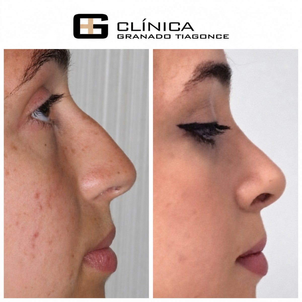 Before and after rhinoplasty results at Clinica Granado Tiagonce, nose reshaping procedure