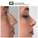 Ergebnisse der Rhinoplastik (Nasenkorrektur) durch Dr. — Vorher- und Nachher-Fotos des Patienten Fotos vor und nach Rhinoplastik (Nasenkorrektur) durch Dr.