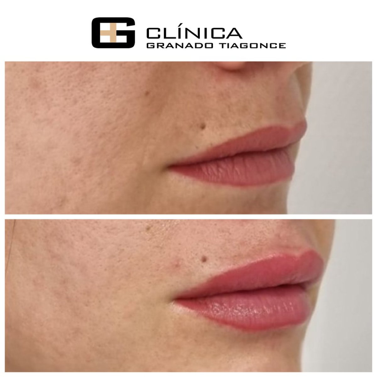 Before and after lip fillers injection at Clinica Granado Tiagonce, enhanced lip volume result