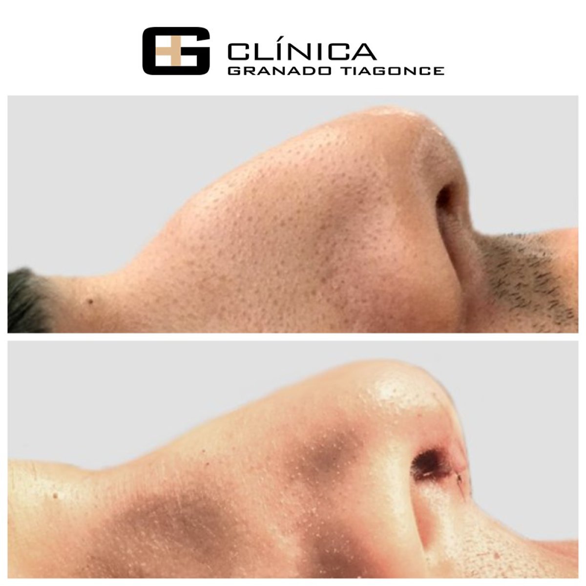 Vorher-nachher-Ergebnis der Nasenkorrektur in der Clinica Granado Tiagonce, verbesserte Nasenform