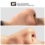 Ergebnisse der Rhinoplastik (Nasenkorrektur) durch Dr. — Vorher- und Nachher-Fotos des Patienten Fotos vor und nach Rhinoplastik (Nasenkorrektur) durch Dr.