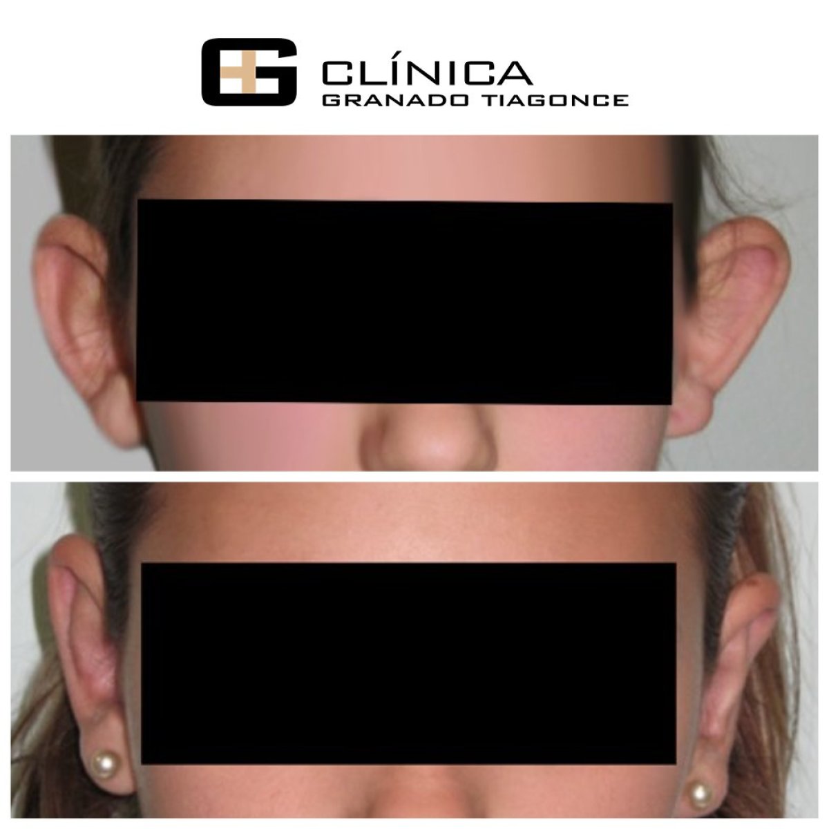 Resultados de otoplastia antes y después en Clinica Granado Tiagonce, cirugía de orejas