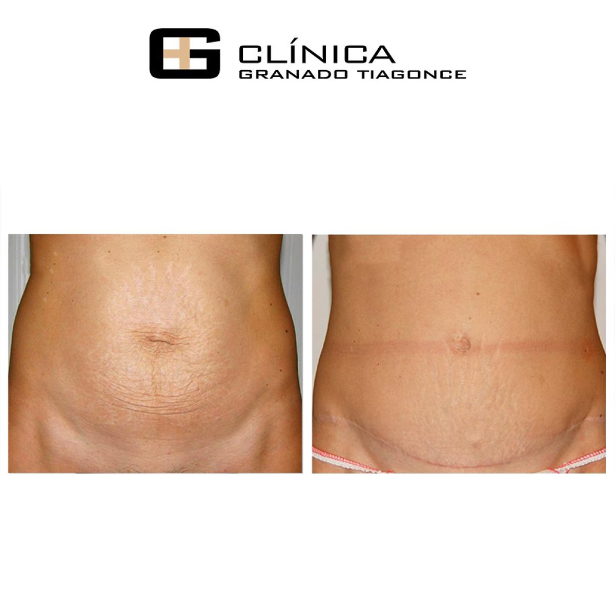 Before and after liposuction results at Clinica Granado Tiagonce, abdomen contour improvement