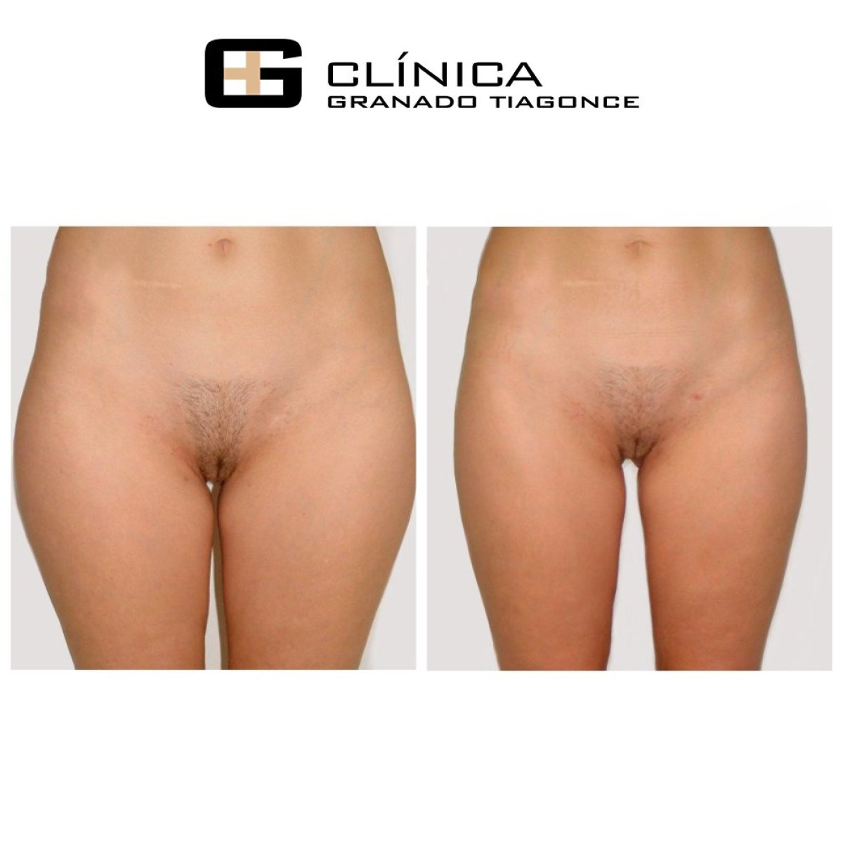 Before and after liposuction results at Clinica Granado Tiagonce, inner thigh contouring