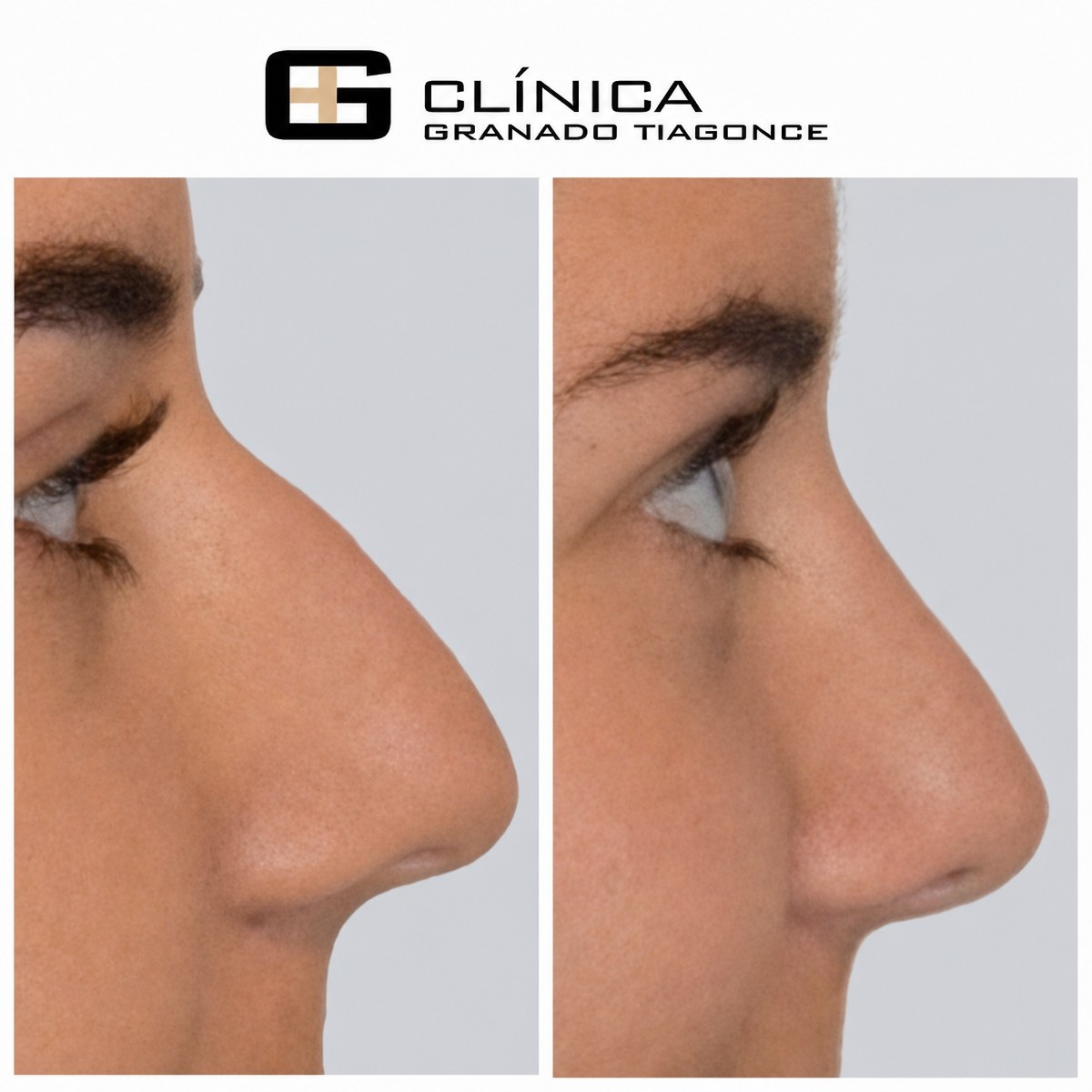 Efekty przed i po rhinoplastyce w Clinica Granado Tiagonce, korekta nosa