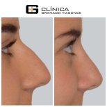 Ergebnisse der Rhinoplastik (Nasenkorrektur) durch Dr. — Vorher- und Nachher-Fotos des Patienten Fotos vor und nach Rhinoplastik (Nasenkorrektur) durch Dr.