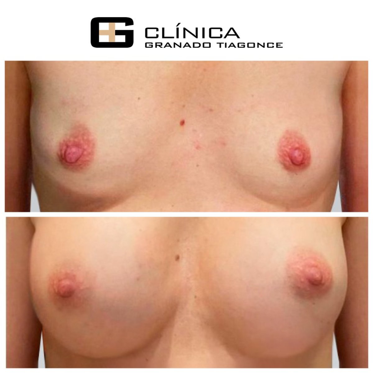 Результаты до и после увеличения груди в Clinica Granado Tiagonce, улучшенная форма