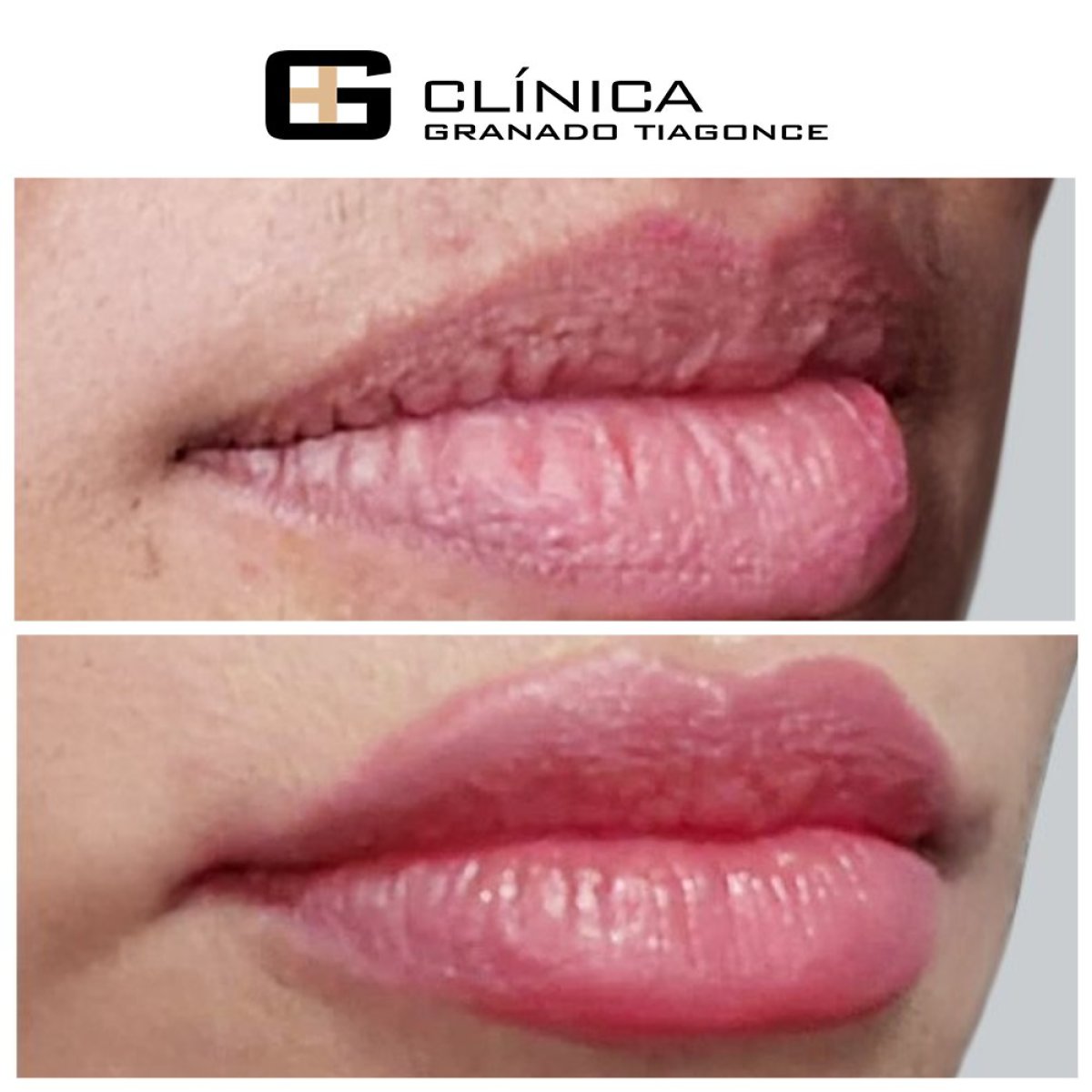 До и после инъекций филлеров в Clinica Granado Tiagonce, заметное увеличение губ