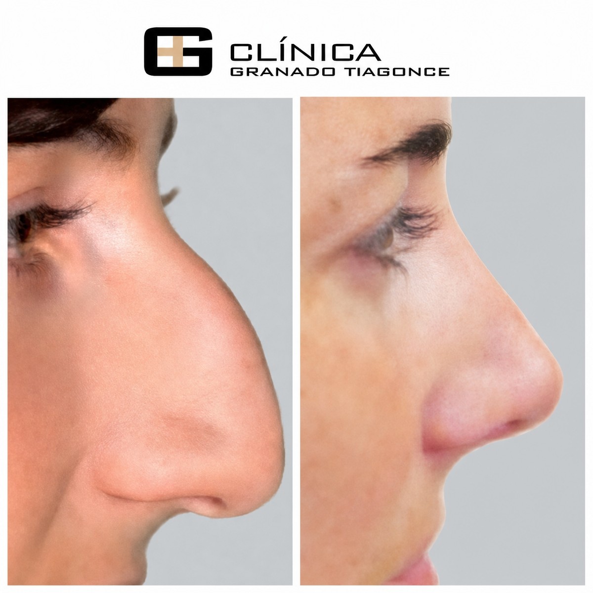 Resultados de rinoplastia antes y después en Clinica Granado Tiagonce, remodelación nasal