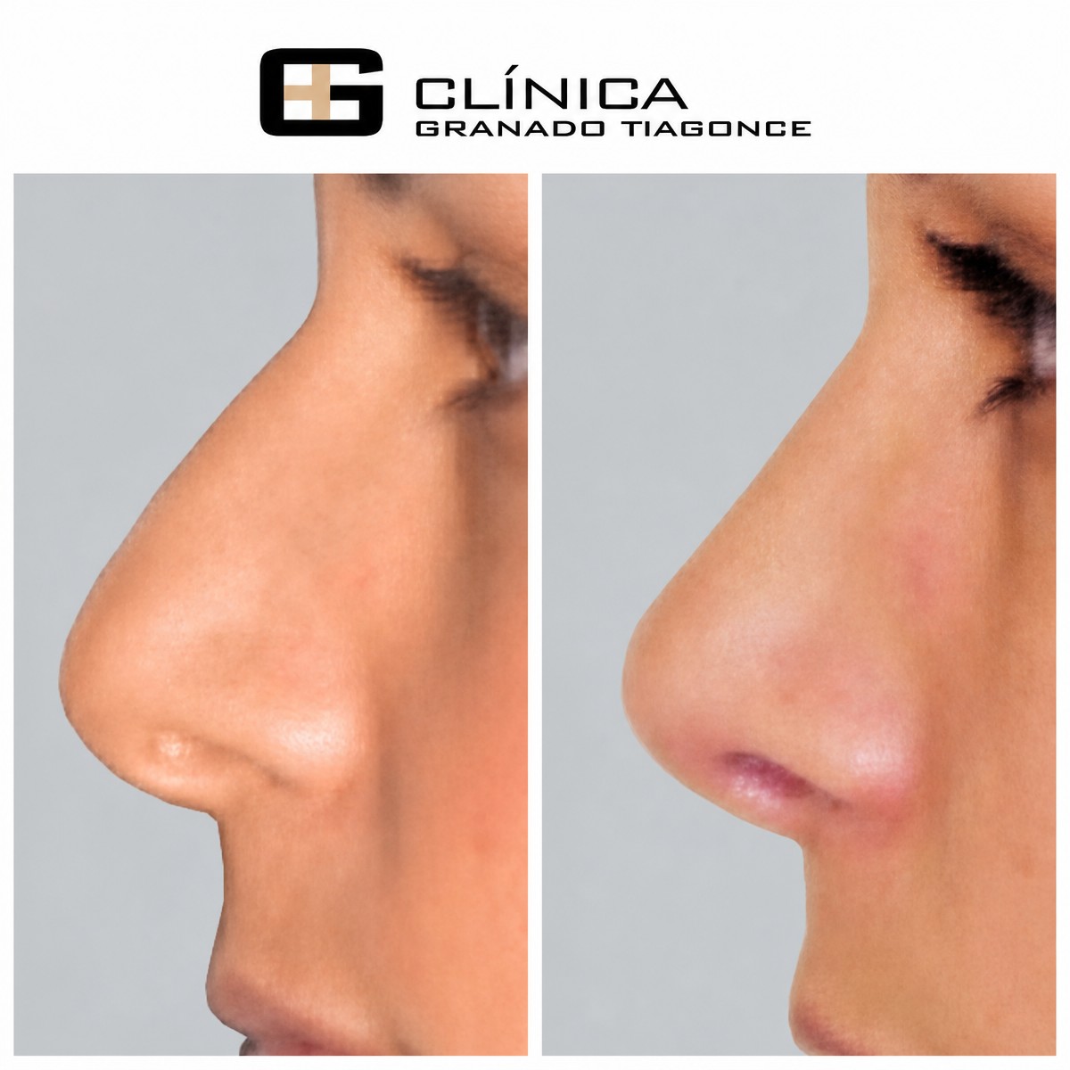 Resultados de rinoplastia antes y después en Clinica Granado Tiagonce, remodelación nasal