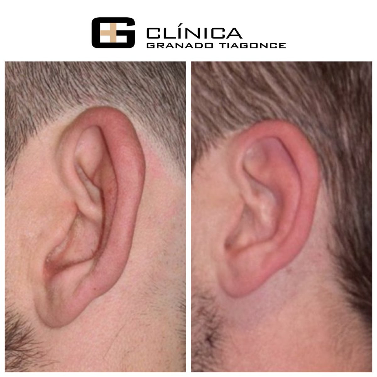 Before and after otoplasty results at Clinica Granado Tiagonce, ear reshaping surgery