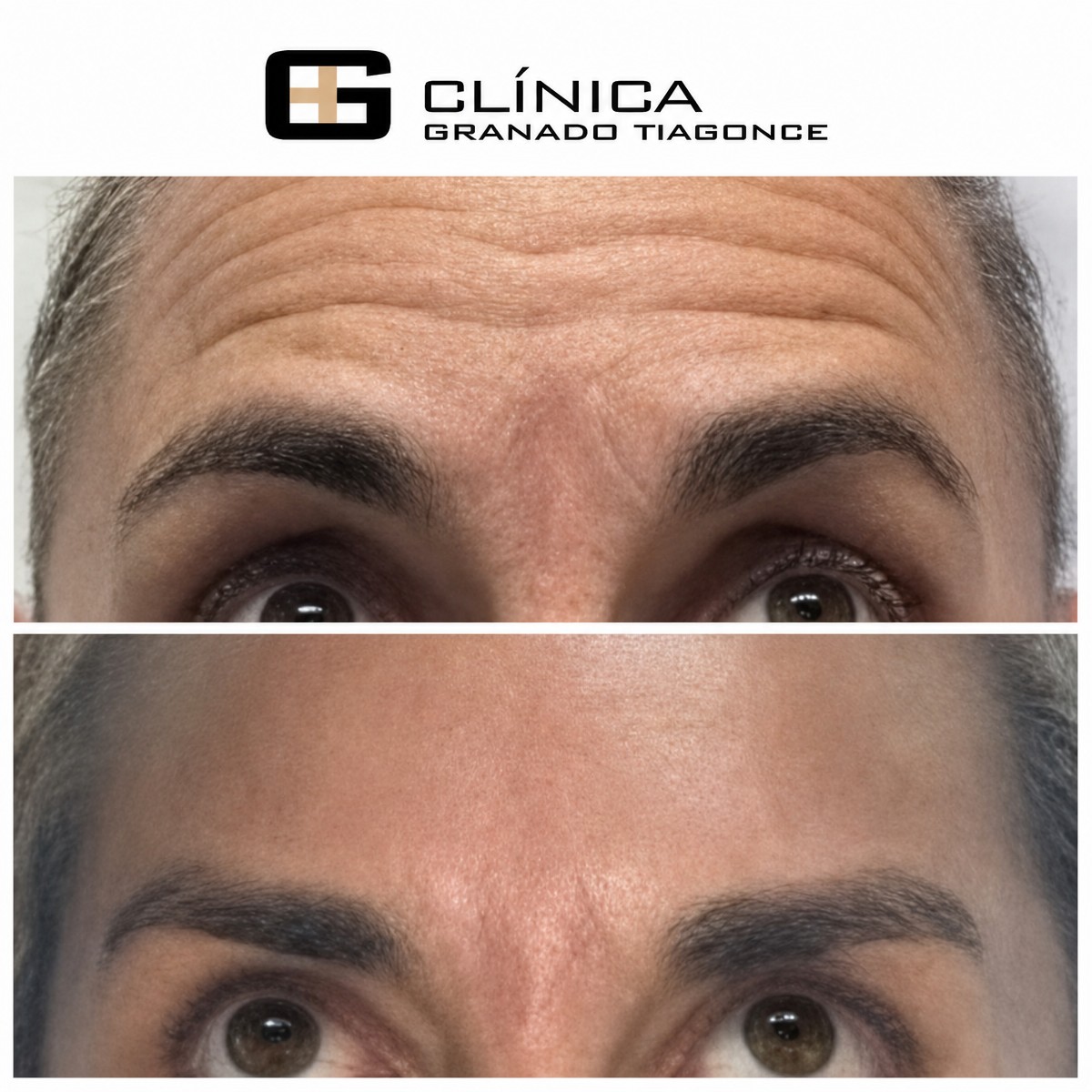 قبل وبعد حقن الفيلر في Clinica Granado Tiagonce، نتيجة تقليل تجاعيد الجبهة