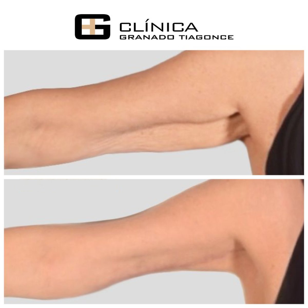 Resultados de lifting de brazos antes y después en Clinica Granado Tiagonce, braquioplastia