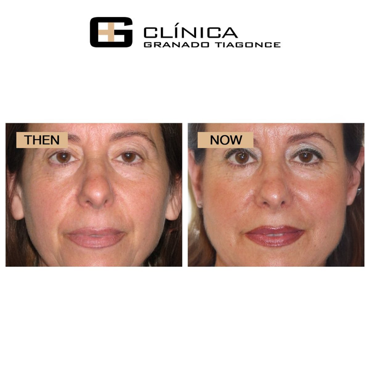 Resultados de lifting facial antes y después en Clinica Granado Tiagonce, rejuvenecimiento facial