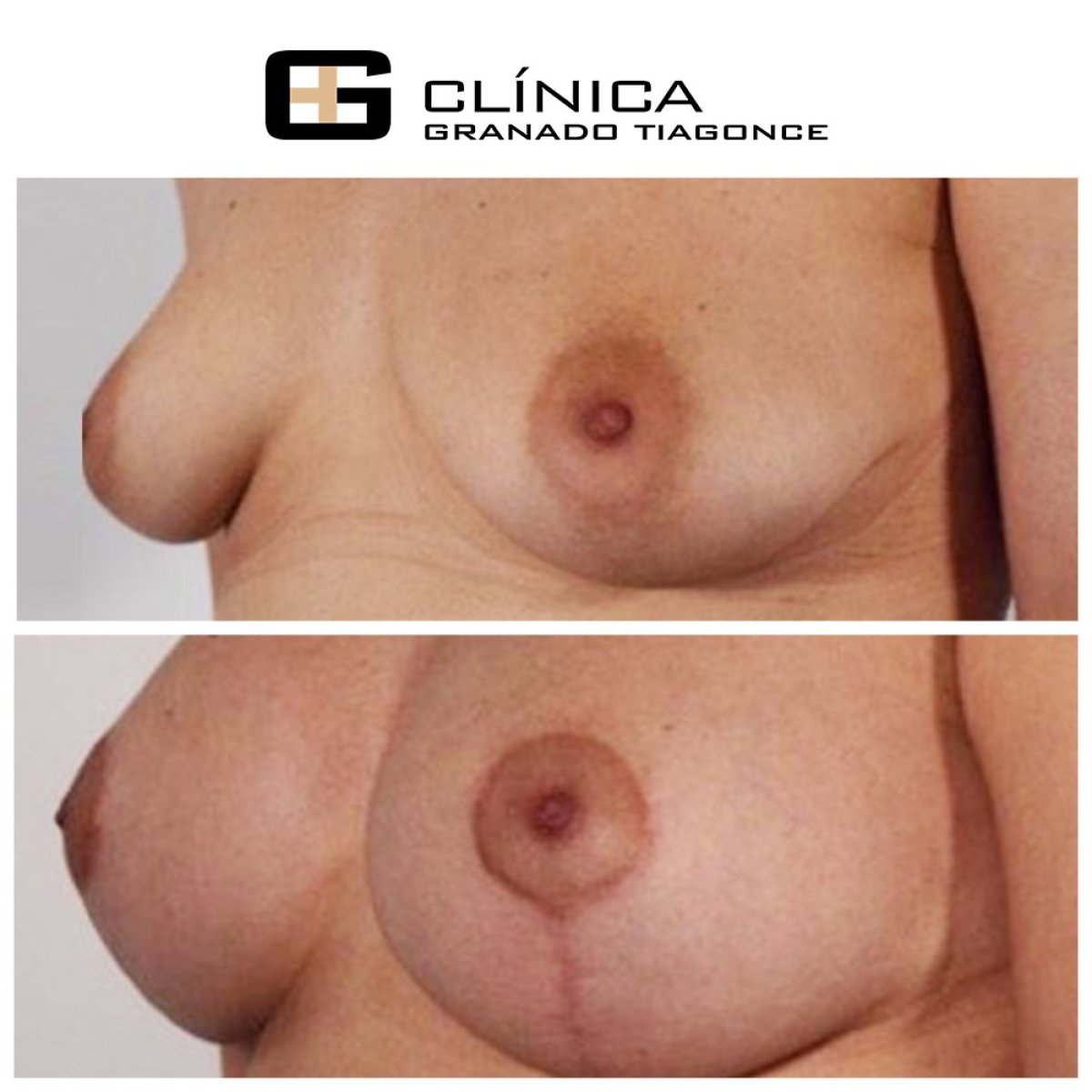 Before and after breast augmentation results at Clinica Granado Tiagonce, fuller breasts