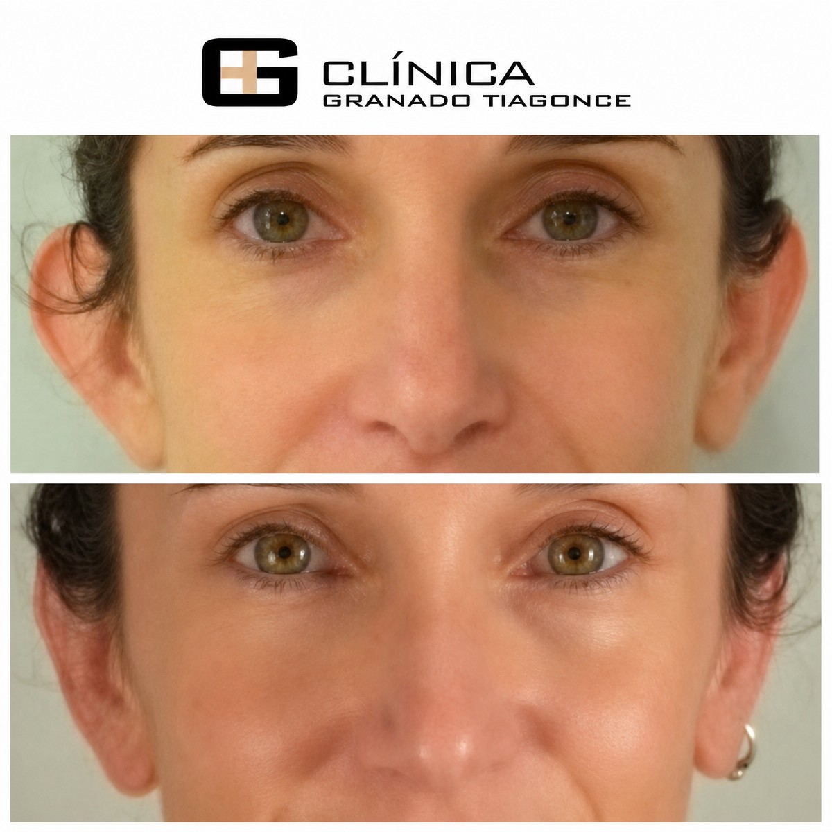 نتائج عملية تجميل الأذن قبل وبعد في Clinica Granado Tiagonce، تصحيح الأذن