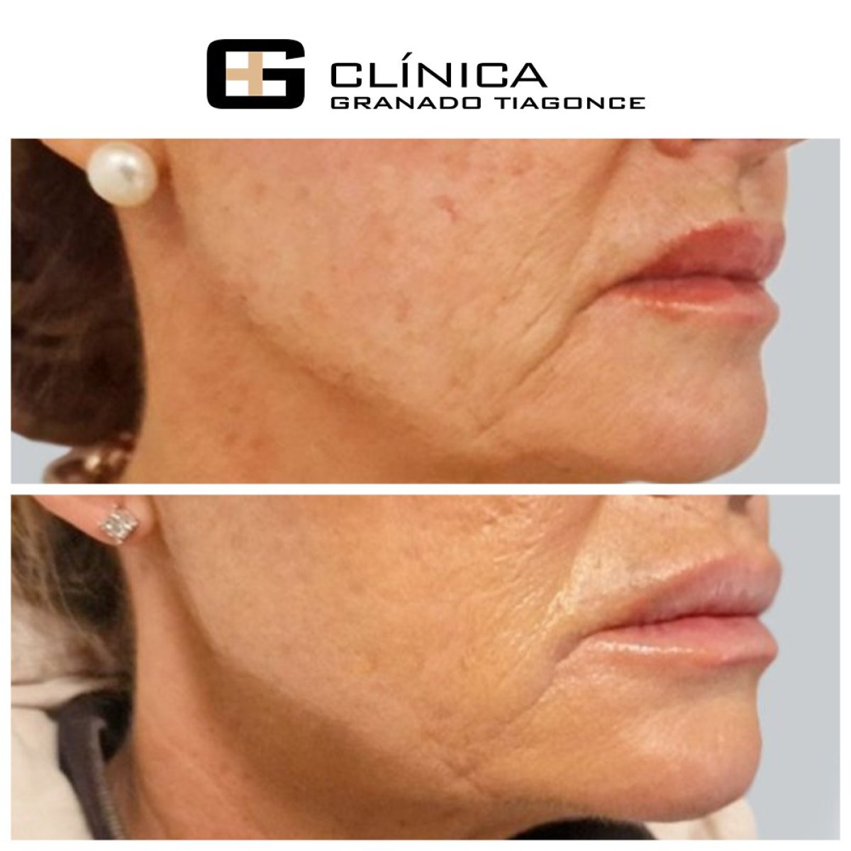 قبل وبعد حقن الفيلر في Clinica Granado Tiagonce، تقليل تجاعيد الوجه