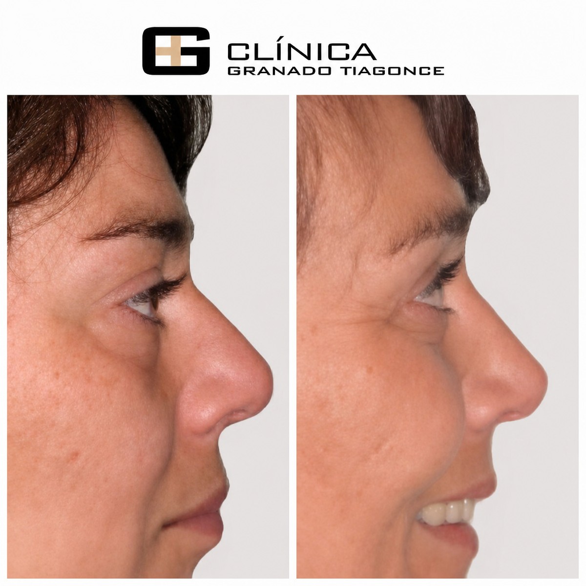 Resultados de rinoplastia antes y después en Clinica Granado Tiagonce, perfil nasal mejorado