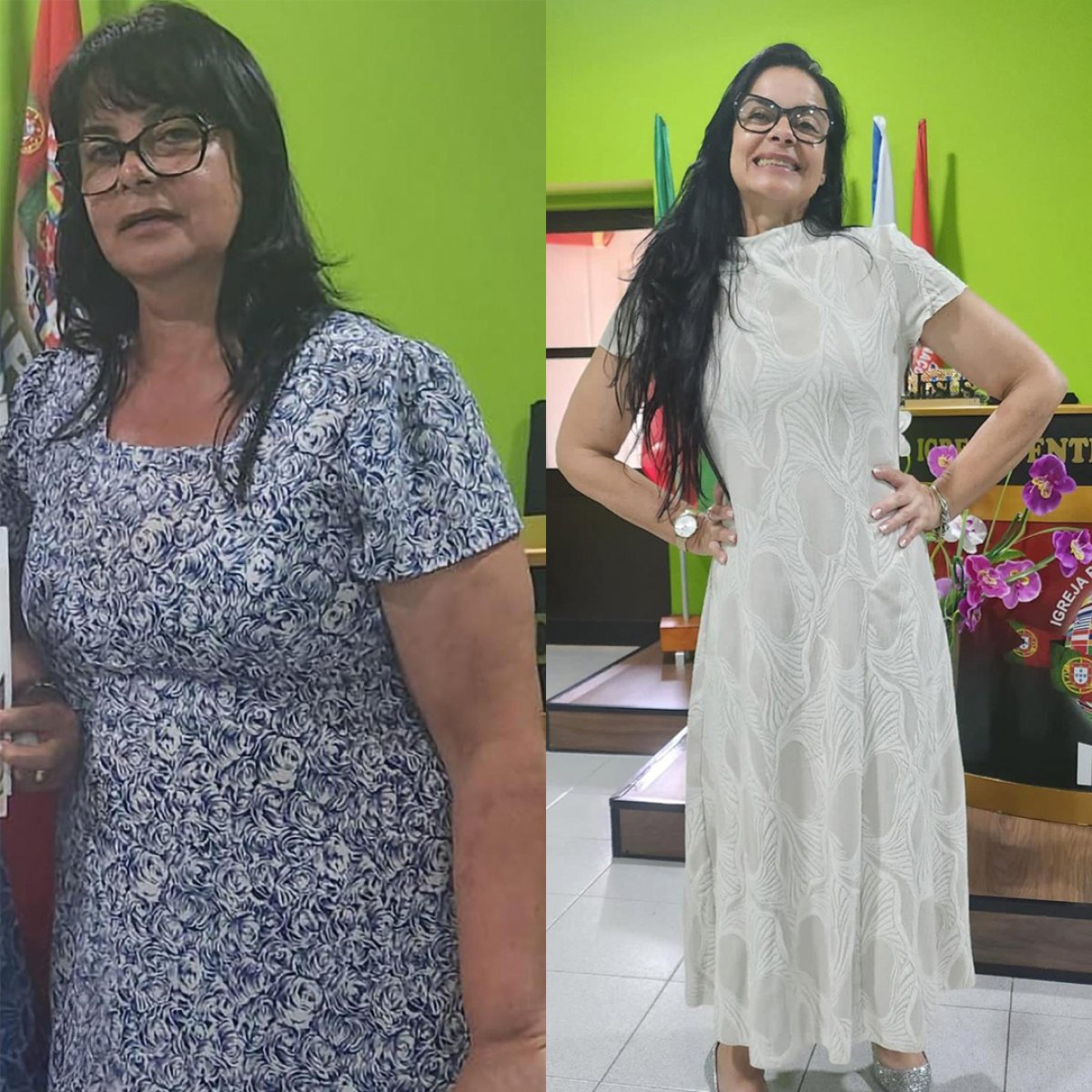 Gastric balloon before and after results – significant weight loss and body contour improvement