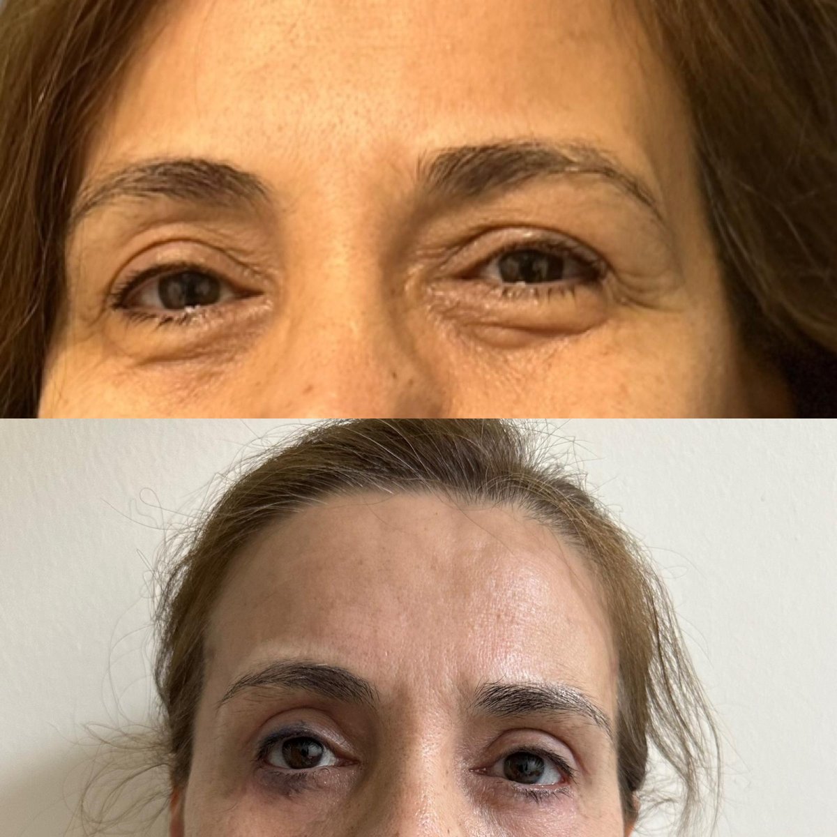 Vorher-nachher-Ergebnisse der Blepharoplastik in der VM Medical Park Florya Klinik, Lidkorrektur