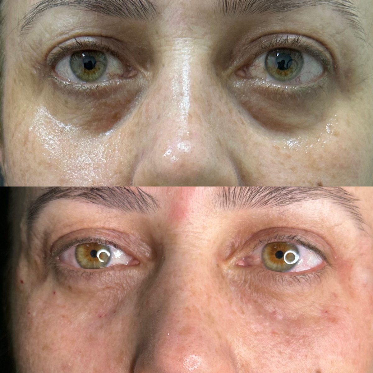 Blepharoplasty before and after results at VM Medical Park Florya Hospital, eyelid correction