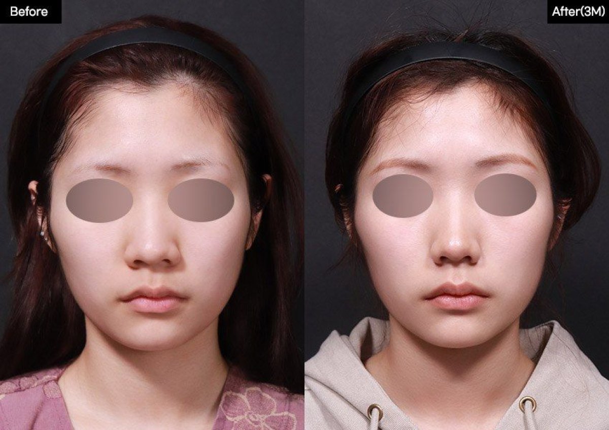 نتائج قبل وبعد عملية تصغير فتحات الأنف في VG Plastic Surgery، تحسين شكل وتناسق الأنف