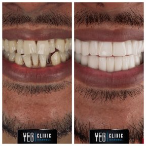 Dental Implant with Lifetime Warranty — 5★ Hotel & VIP Transfer Included - photo 5