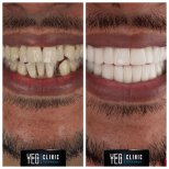 صور قبل وبعد زرع الأسنان للدكتور Omer Oner